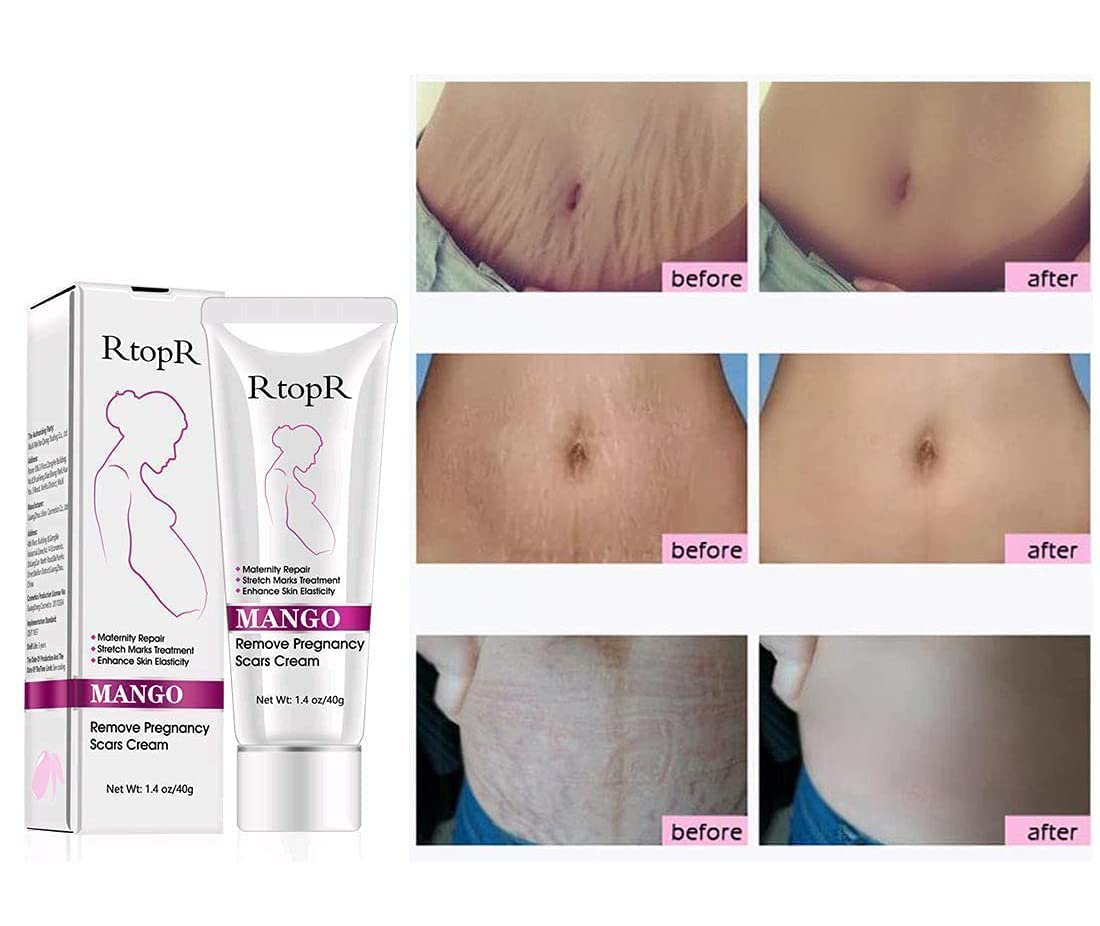 RtopR Mango Stretch Marks and Scar Cream -Stretch Marks and Scar Removal Cream for Pregnancy - Best Body Moisturizer-40g