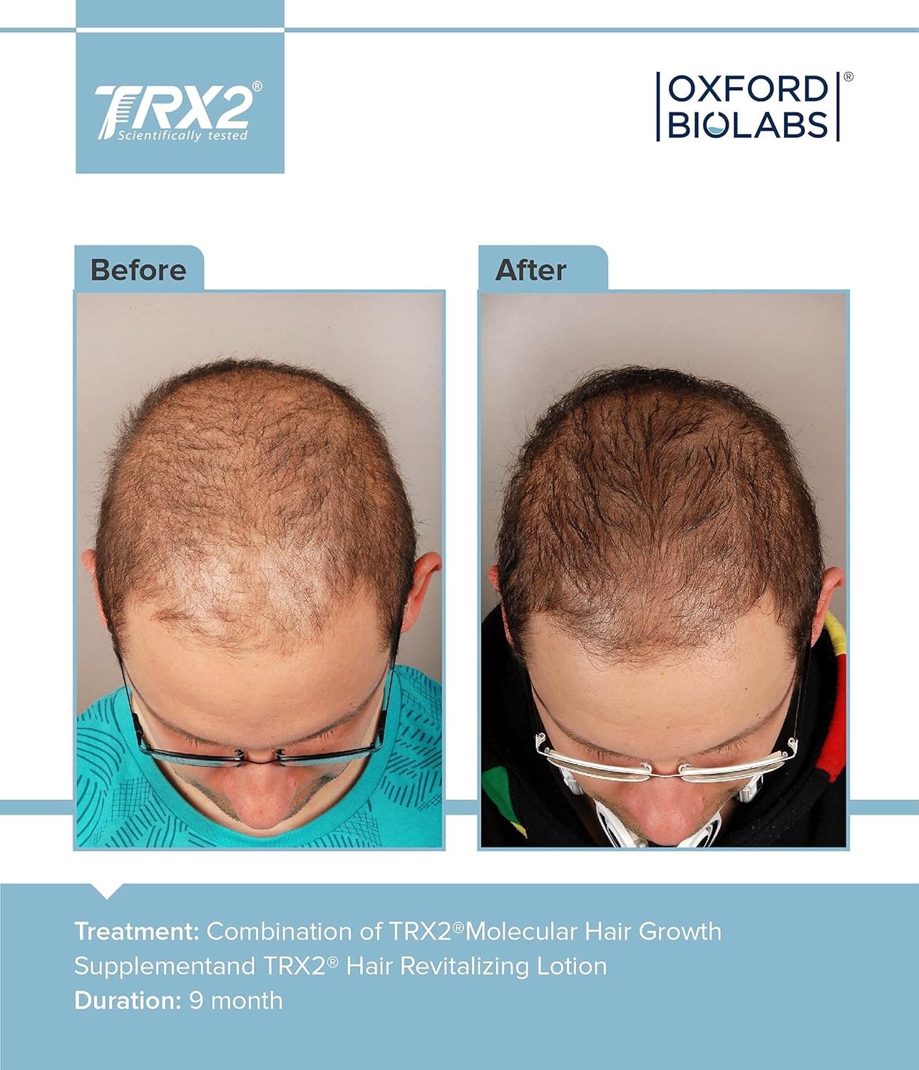TRX2 Hair Growth Supplement - Stop Hair Loss for Men and Women - Healthy Hair - Clinically Proven Results of Thicker, Fuller Hair - Biotin & Selenium & Zink - Vegetarian - 1 Month Supply